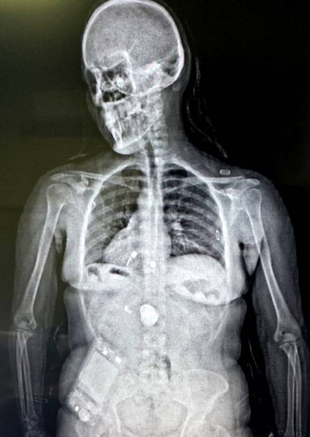 Pareja detenida tras ingerir 196 cápsulas con cocaína- Pareja detenida tras ingerir 196 cápsulas con cocaína