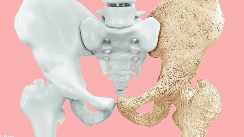 Aprobaron un nuevo y revolucionario tratamiento contra la osteoporosis que promete "regenerar" los huesos