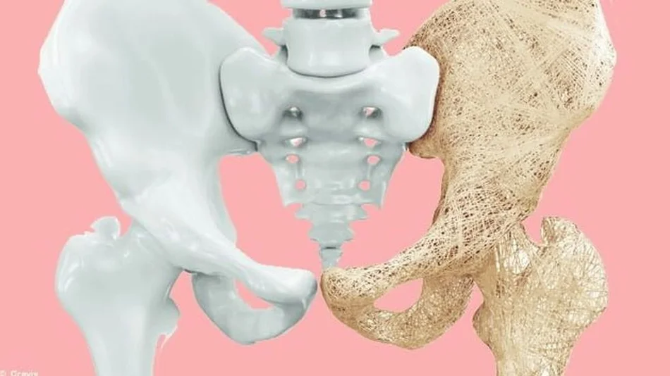 Aprobaron un nuevo y revolucionario tratamiento contra la osteoporosis que promete "regenerar" los huesos
