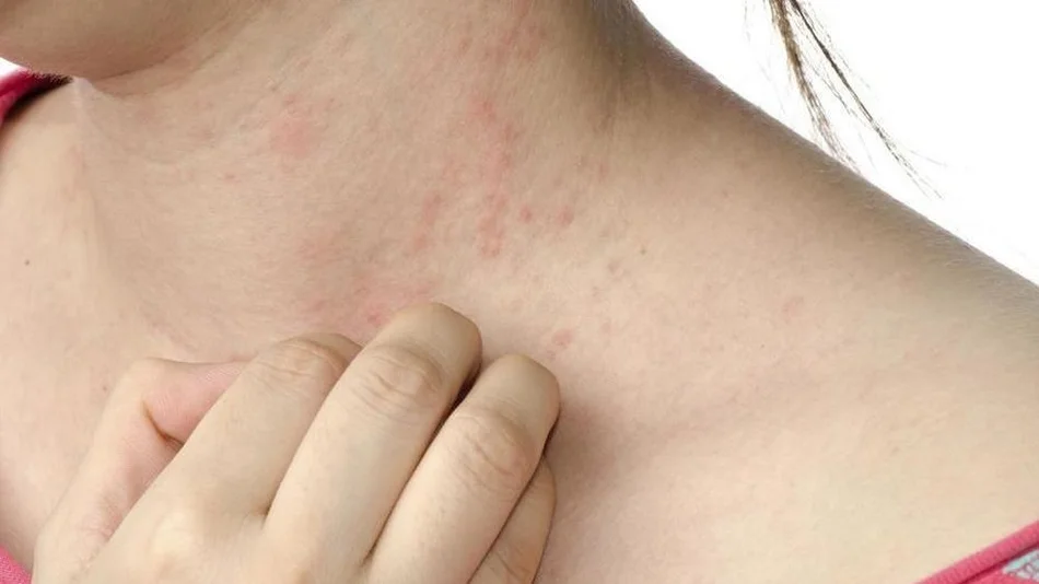 Un nuevo tratamiento para la psoriasis logra reducir el 90% de las placas en la mayoría de los pacientes