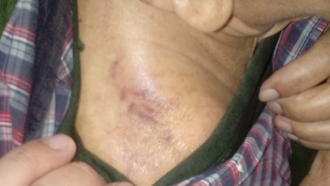 Tiene 77 años, se quebró la clavícula y no lo quieren operar: lo mandaron a la casa 
