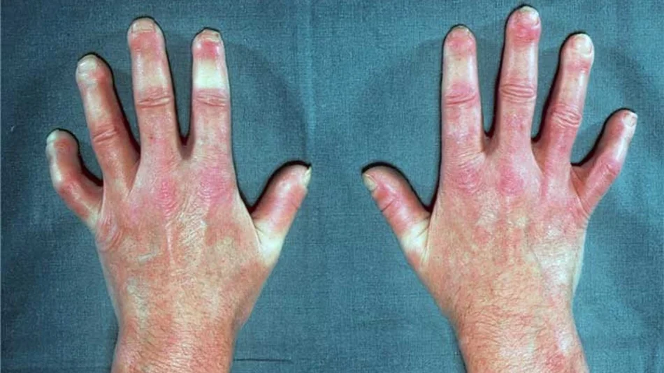 Esclerodermia, más allá del endurecimiento de la piel