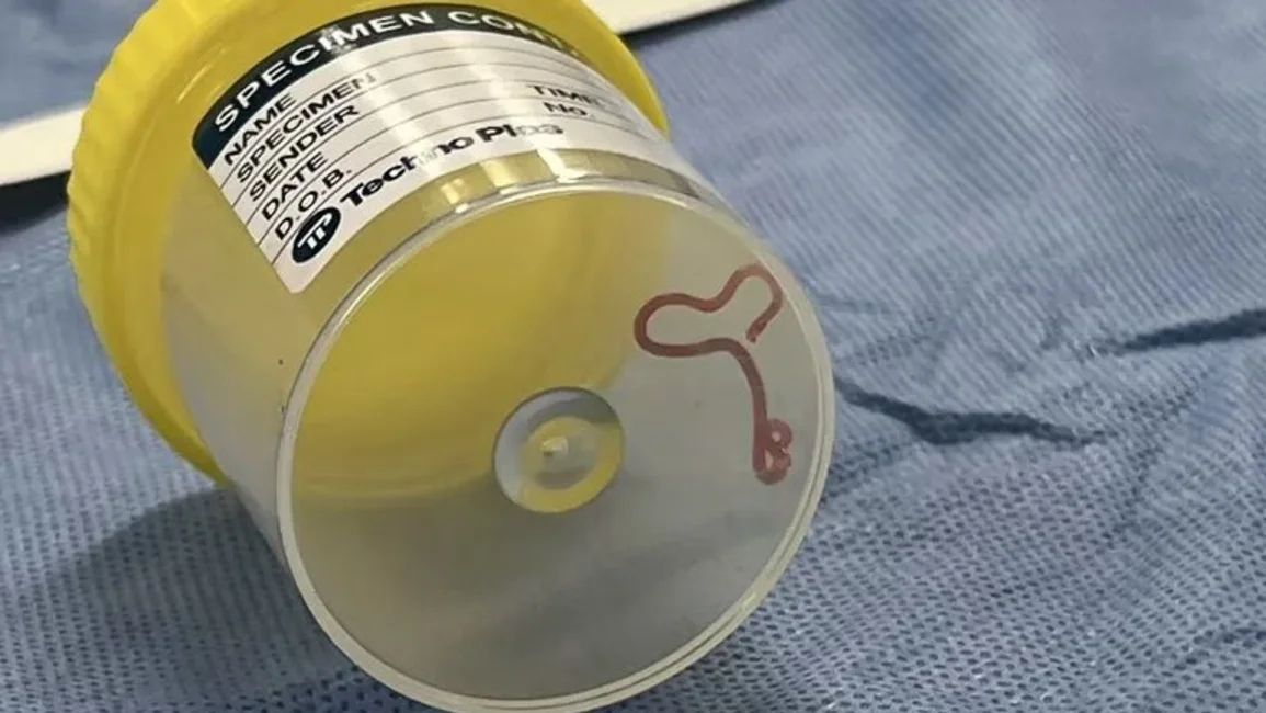 Una neurocirujana encontró un gusano en el cerebro de una paciente