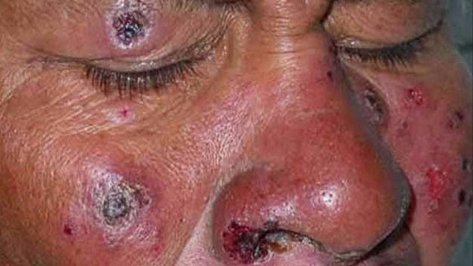 Aumentan los casos de leishmaniasis