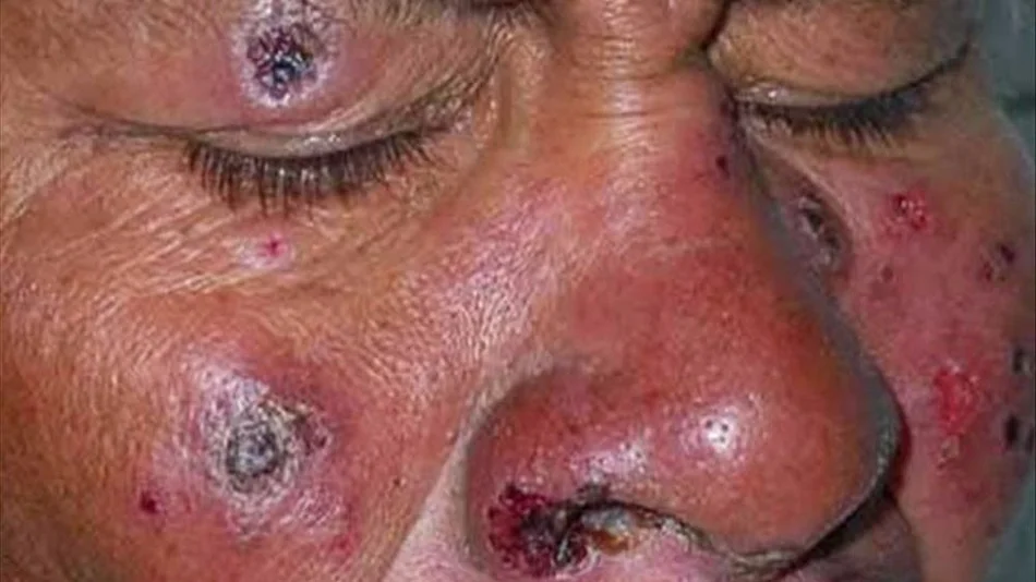 Aumentan los casos de leishmaniasis