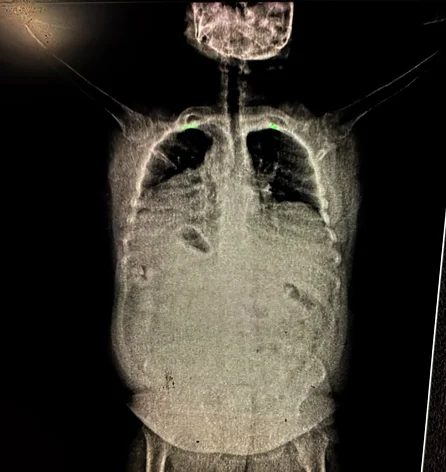 Salió de Salta con casi 200 cápsulas de cocaína en su cuerpo: detuvieron a una mujer y a su reclutador- Salió de Salta con casi 200 cápsulas de cocaína en su cuerpo: detuvieron a una mujer y a su reclutador