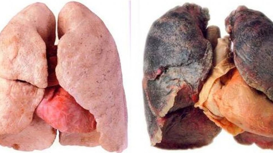 Logran detectar el cáncer de pulmón con un análisis