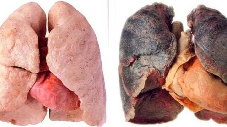 Logran detectar el cáncer de pulmón con un análisis