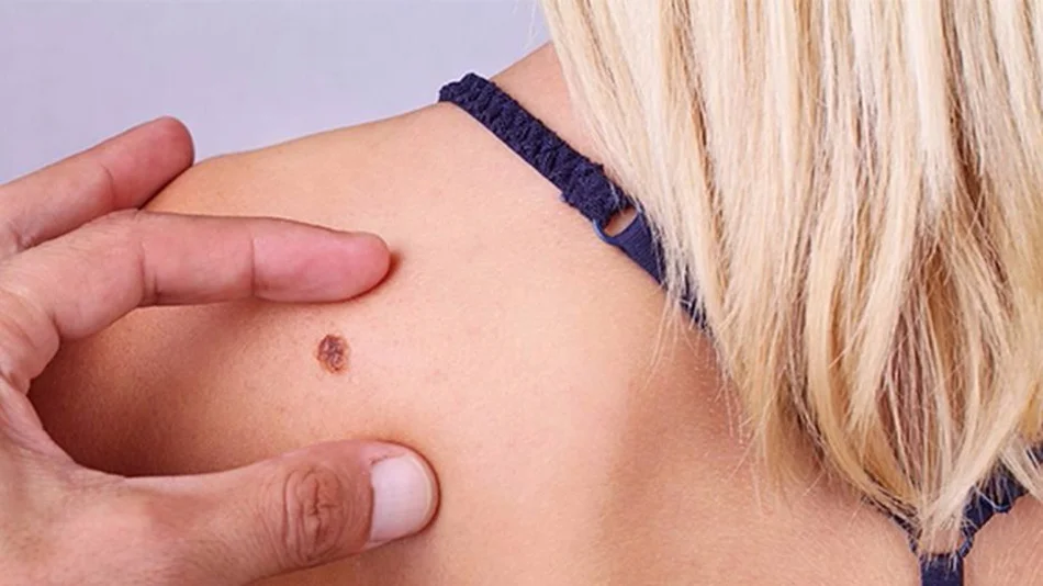 Unos 550 argentinos mueren anualmente a causa del melanoma