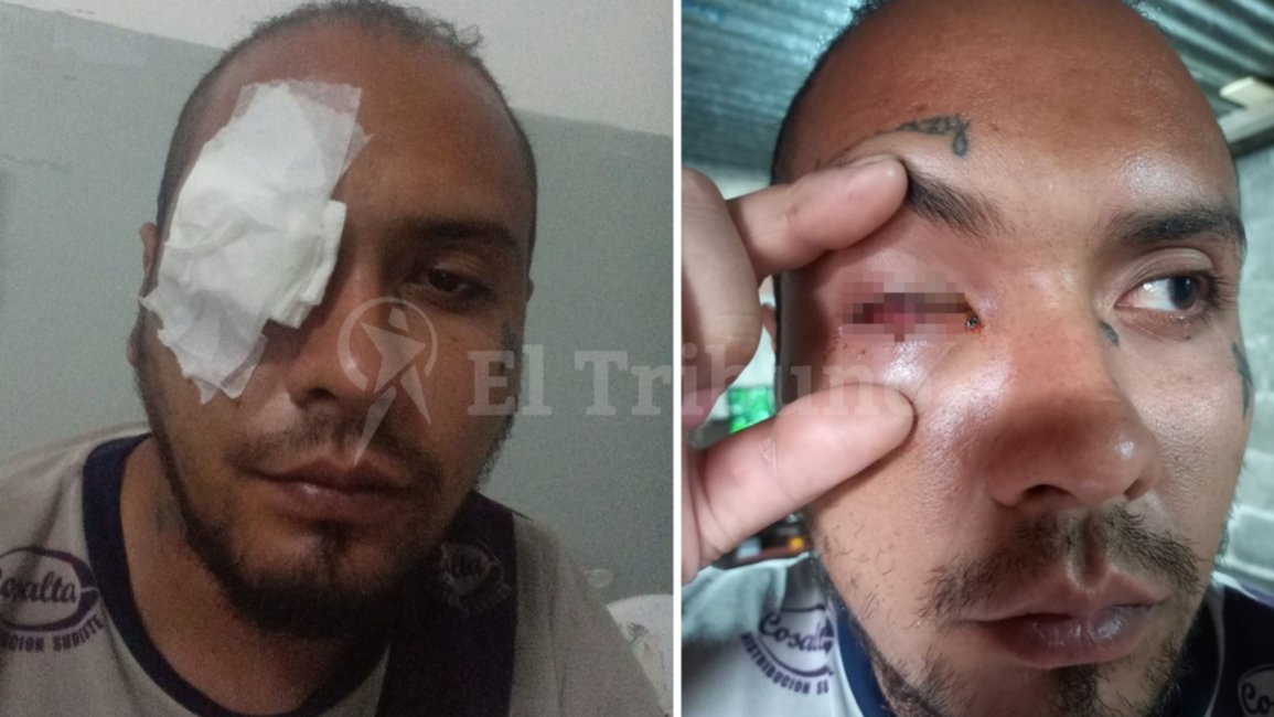Barrio Castañares: un joven perdió un ojo luego de que la policía le disparara y lo confundiera con un grupo de chicos que perseguían