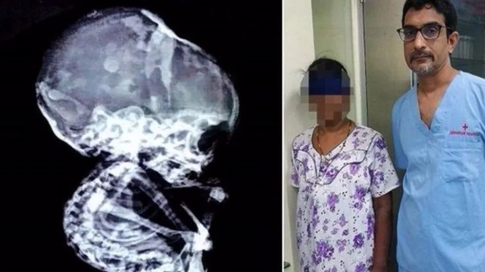 Una mujer llevó un bebé “petrificado” dentro de su cuerpo durante 15 años 
